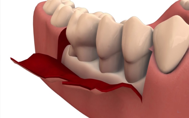 Flap Surgery